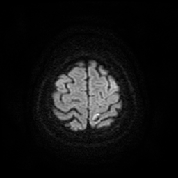 Cerebral metastases - melanoma (Radiopaedia 80972-94522 Axial DWI 58).jpg