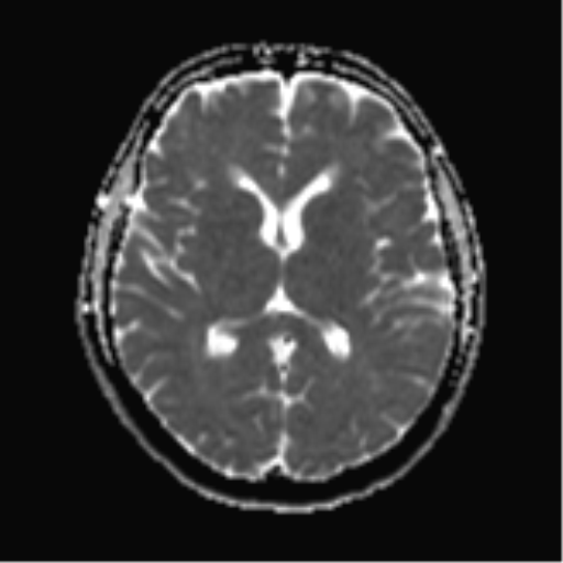 File:Cerebral metastases mimicking abscesses (Radiopaedia 45841-50131 Axial ADC 16).png