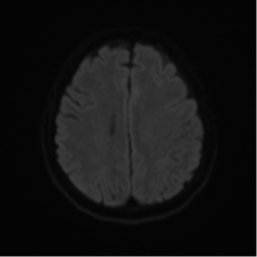 Cerebral metastases mimicking abscesses (Radiopaedia 45841-50131 Axial DWI 48).png