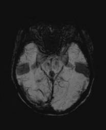 File:Cerebral metastasis (Radiopaedia 46744-51248 Axial SWI 12).png