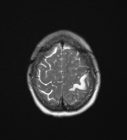 File:Cerebral metastasis (Radiopaedia 46744-51248 Axial T2 24).png