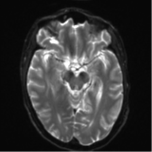 Cerebral metastasis - melanoma (Radiopaedia 54718-60954 Axial DWI 13).png