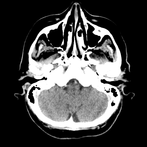 Cerebral metastasis to basal ganglia (Radiopaedia 81568-95412 Axial C+ delayed 14).png