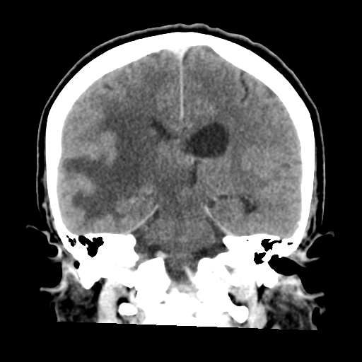 Cerebral metastasis to basal ganglia (Radiopaedia 81568-95412 Coronal C+ delayed 37).png