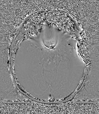Cerebral metastasis to basal ganglia (Radiopaedia 81568-95413 Axial SWI phase 33).png