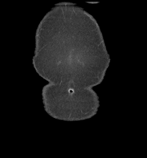 Cerebral metastasis to basal ganglia (Radiopaedia 81568-95414 F 5).png