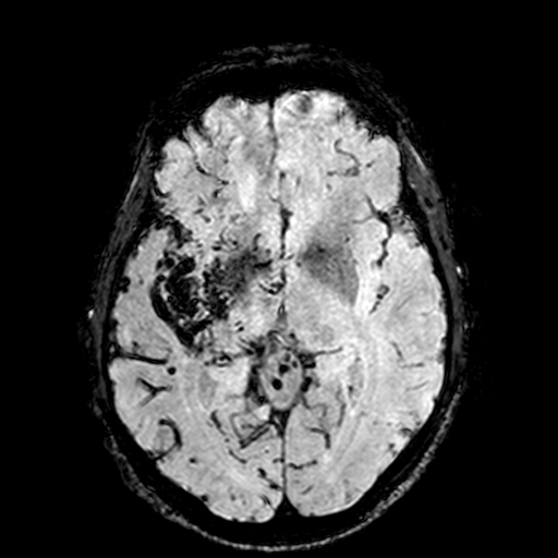 Cerebral parenchymal arteriovenous malformation (Radiopaedia 27280-27456 Axial SWI 53).jpg