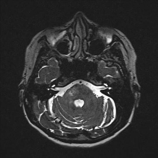 Cerebral ring enhancing lesions - cerebral metastases (Radiopaedia 44922-48817 F 37).jpg