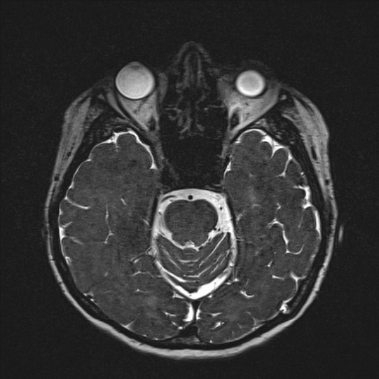 Cerebral ring enhancing lesions - cerebral metastases (Radiopaedia 44922-48817 F 59).jpg
