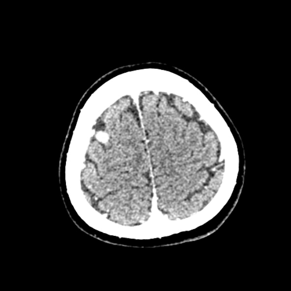File:Cerebral ring enhancing lesions - cerebral metastases (Radiopaedia 44922-48818 B 244).jpg