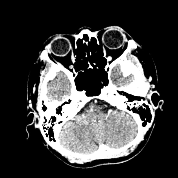 Cerebral ring enhancing lesions - cerebral metastases (Radiopaedia 44922-48818 B 65).jpg
