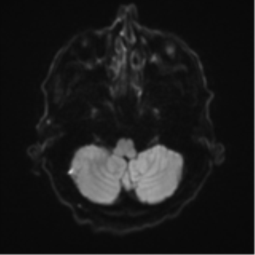 Cerebral toxoplasmosis (Radiopaedia 54575-60804 Axial DWI 40).png