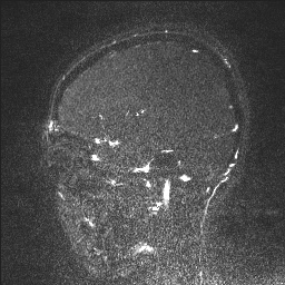 Cerebral tuberculosis with dural sinus invasion (Radiopaedia 60353-68090 Sagittal MRV 34).jpg