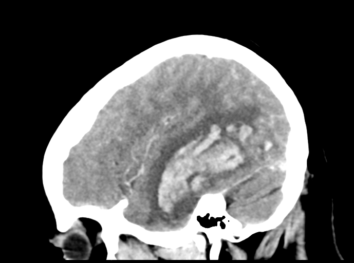 Cerebral venous hemorrhagic infarction (Radiopaedia 57576-64538 Sagittal C+ 14).png