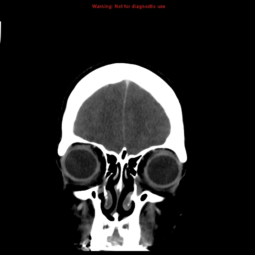 Cerebral venous infarction (Radiopaedia 12404-20735 B 11).jpg