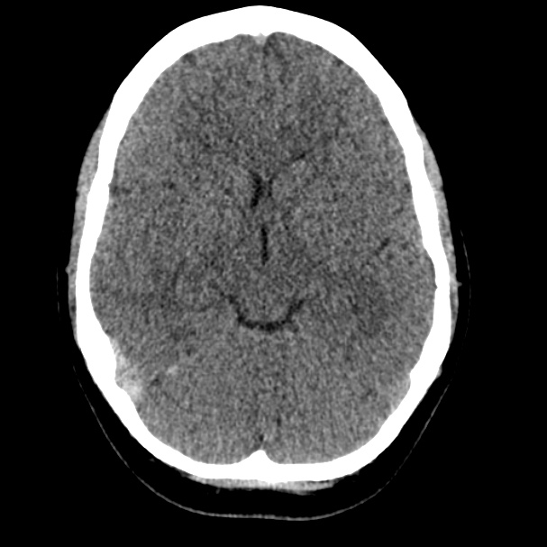 Cerebral venous sinus thrombosis (Radiopaedia 59224-66551 Axial non-contrast 4).jpg