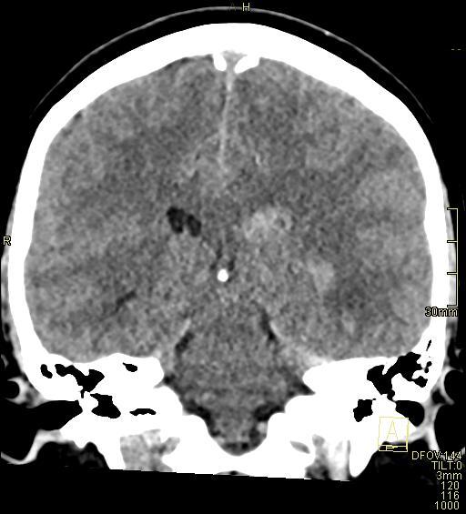 File:Cerebral venous sinus thrombosis (Radiopaedia 91329-108965 Coronal non-contrast 34).jpg