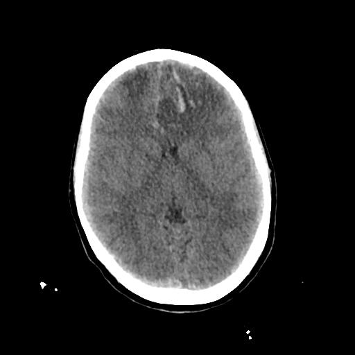 File:Cerebral venous throbmosis - hemorrhagic venous infarction (Radiopaedia 87318-103613 Axial non-contrast 79).jpg
