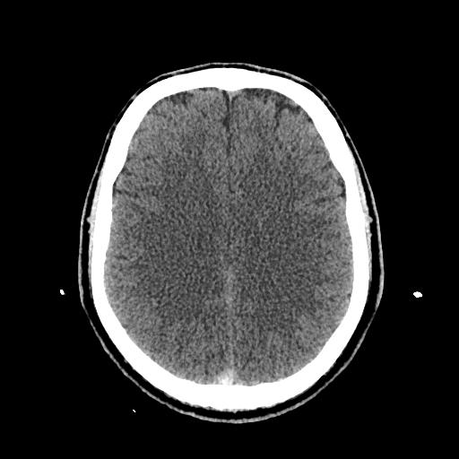 File:Cerebral venous thrombosis (CVT) (Radiopaedia 77524-89685 Axial non-contrast 31).jpg