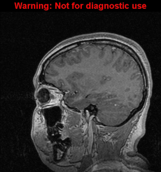 File:Cerebral venous thrombosis (Radiopaedia 37224-39208 Sagittal T1 C+ 46).jpg