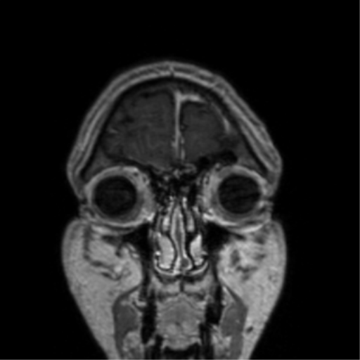 Cerebral venous thrombosis (Radiopaedia 38392-40469 Coronal T1 C+ 81).png