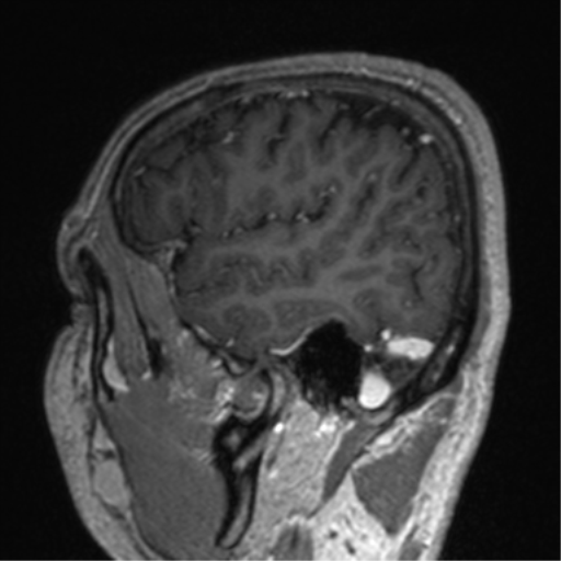 File:Cerebral venous thrombosis (Radiopaedia 38392-40469 Sagittal T1 C+ 71).png