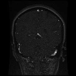 Cerebral venous thrombosis - ulcerative colitis (Radiopaedia 66049-75219 Coronal MRV 42).jpg