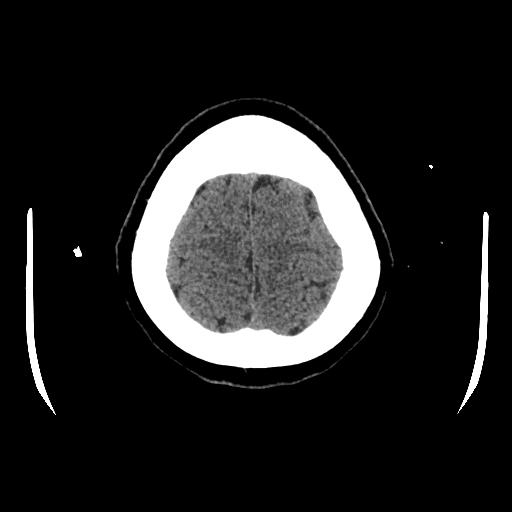 Cerebral venous thrombosis with venous hemorrhagic infarct (Radiopaedia 90354-107660 Axial non-contrast 45).jpg
