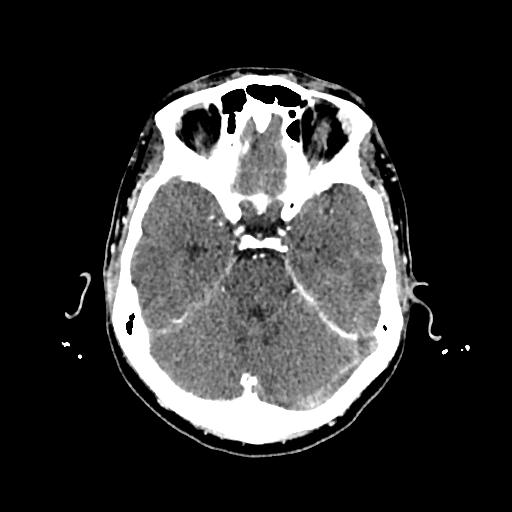 Cerebral venous thrombosis with venous hemorrhagic infarct (Radiopaedia 90354-107660 Axial with contrast 58).jpg