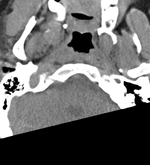File:Cervical canal stenosis - OPLL and osteophytes (Radiopaedia 47329-51910 Axial non-contrast 2).png