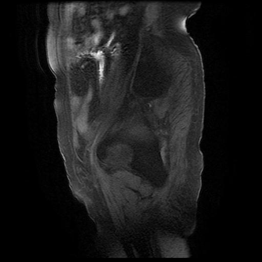 File:Cervical carcinoma (Radiopaedia 78847-91705 Sagittal T1 fat sat 2).jpg