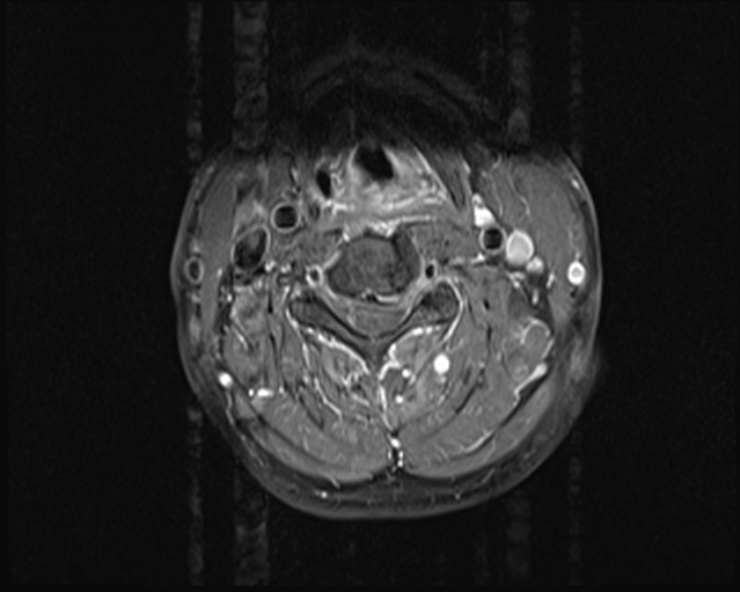 File:Cervical disc extrusion (Radiopaedia 53950-60077 Axial T1 C+ fat sat 11).jpg