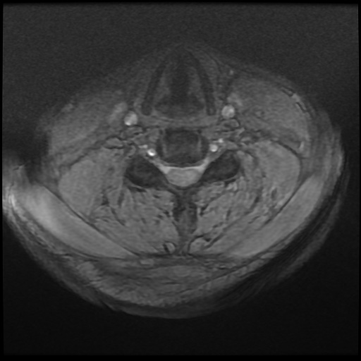 Cervical disc extrusion (Radiopaedia 59074-66364 F 30).jpg