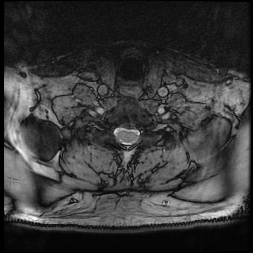 Cervical disc extrusion (Radiopaedia 59074-66364 G 79).jpg