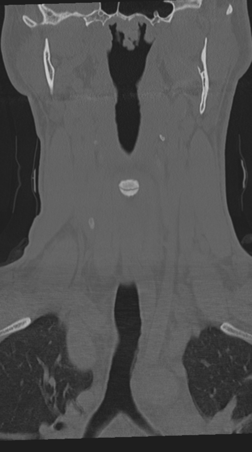 Cervical intercalary bone (Radiopaedia 35211-36748 Coronal bone window 23).png