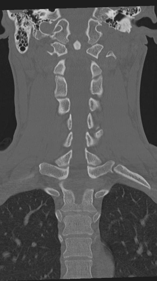 Cervical intercalary bone (Radiopaedia 35211-36748 Coronal bone window 44).png