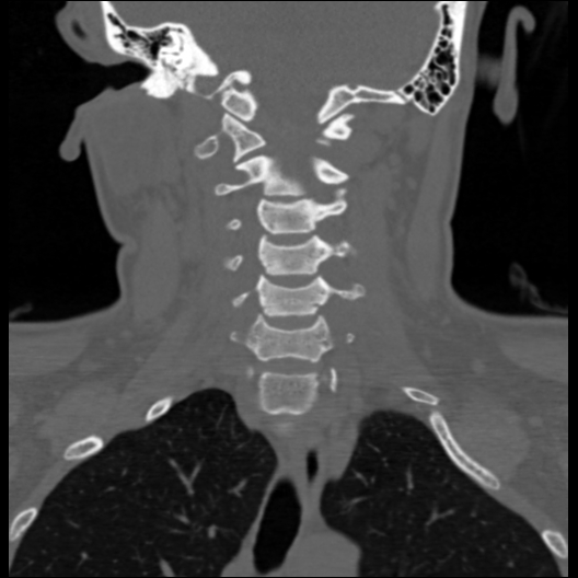 File:Cervical rib (Radiopaedia 71110-81363 Coronal non-contrast 26).jpg