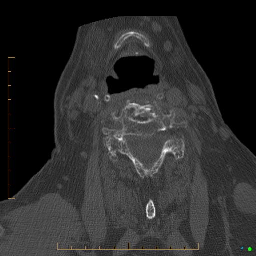 Cervical spine fracture - ankylosing spondylitis (Radiopaedia 76835-88706 Axial bone window 131).jpg