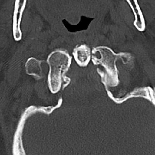 File:Cervical spine fracture - chalk stick (Radiopaedia 39116-41323 Axial bone window 15).png