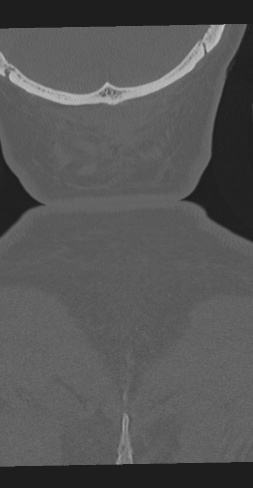 Cervical spine fracture in the setting of ankylosis (Radiopaedia 37038-38715 Coronal bone window 75).png