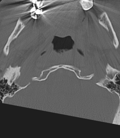 Cervical spine fractures with vertebral artery dissection (Radiopaedia 53296-59268 Axial bone window 6).png
