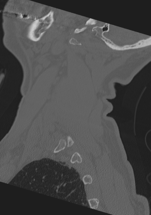 Cervical spine fractures with vertebral artery dissection (Radiopaedia 53296-59268 Sagittal bone window 62).png
