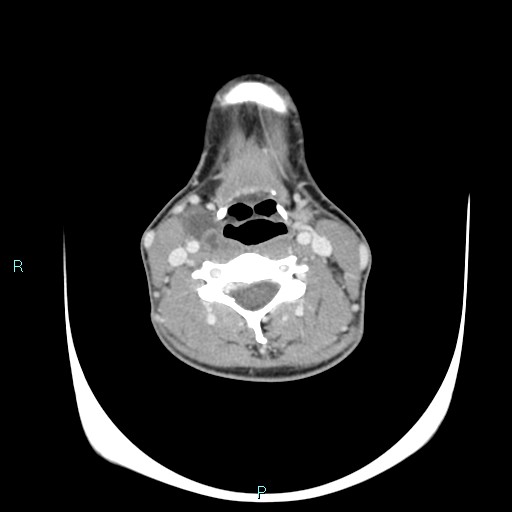 Cervical thymic cyst (Radiopaedia 88632-105335 C 62).jpg