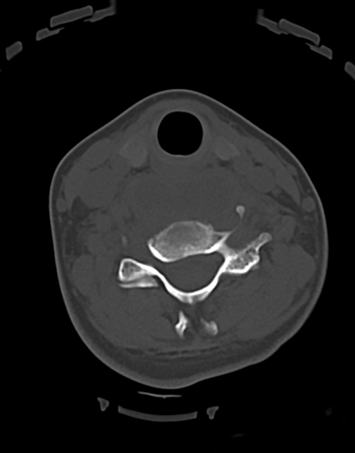 Cervical tuberculous spondylitis (Radiopaedia 39149-41365 Axial bone window 34).png