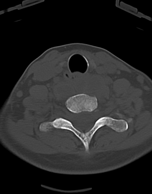 Cervical tuberculous spondylitis (Radiopaedia 39149-41365 Axial bone window 42).png