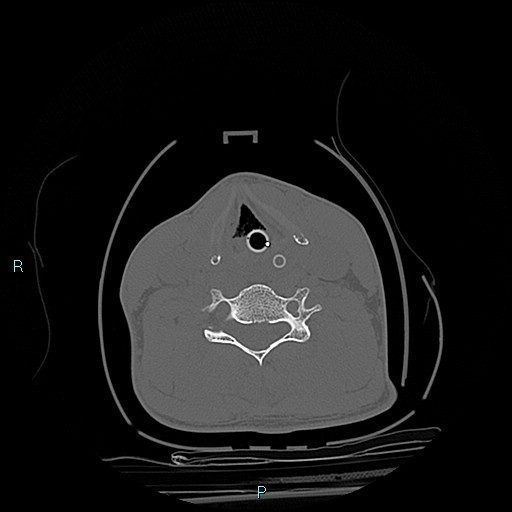 File:Cervical vertebral burst fracture (Radiopaedia 37420-39258 Axial bone window 4).jpg