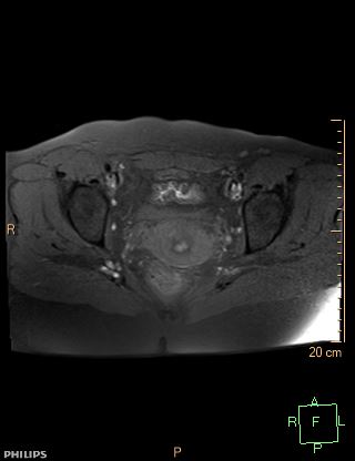 File:Cesarian scar endometriosis (Radiopaedia 68495-78066 Axial T1 fat sat 16).jpg