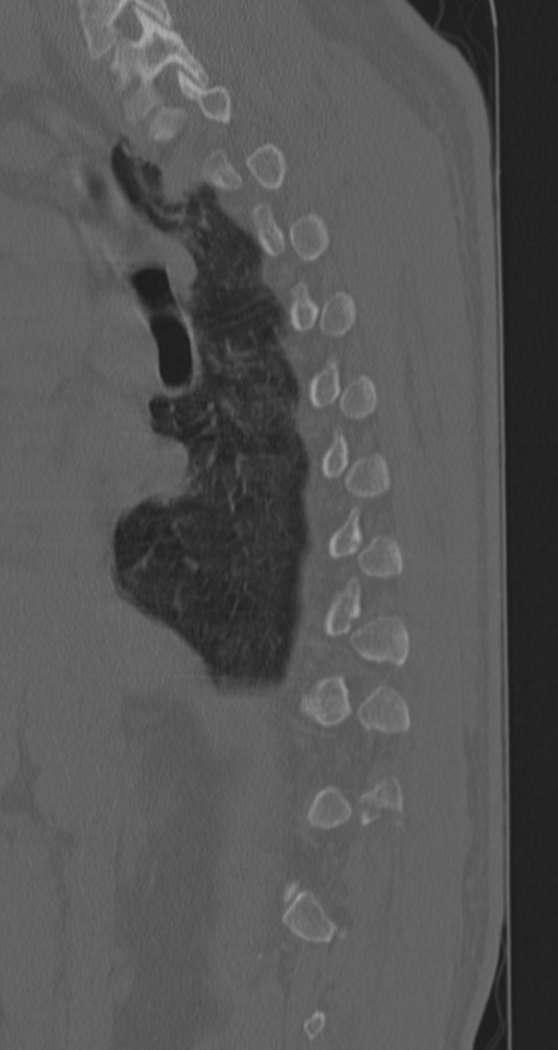 Chance fracture (Radiopaedia 33854-35020 Sagittal bone window 59).png