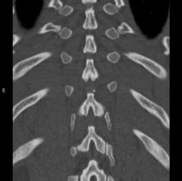 File:Chance fracture (Radiopaedia 36521-38081 Coronal bone window 52).jpg
