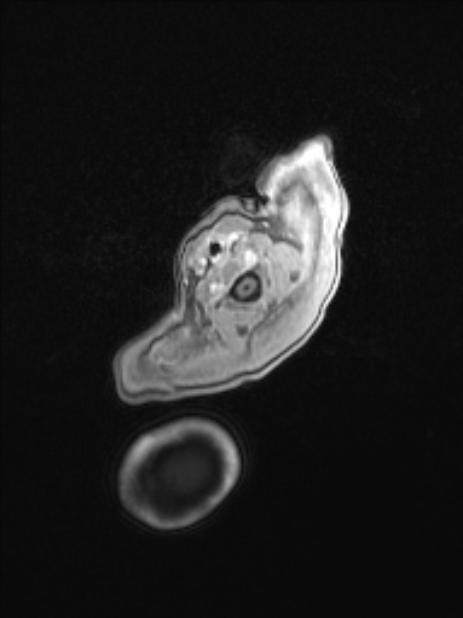 Chiari III malformation with occipital encephalocele (Radiopaedia 79446-92559 Axial T1 C+ mpr 11).jpg